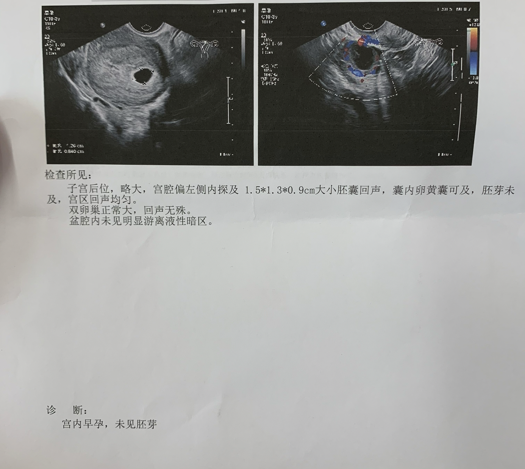 关于两个月未月经来临的探讨